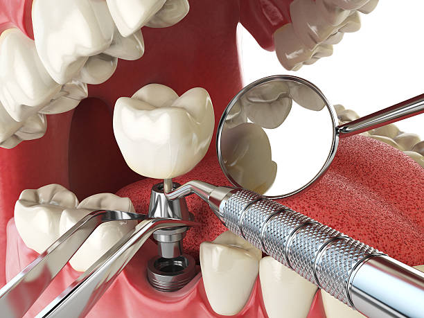 Best Emergency Denture Repair in Audubon, IA